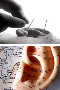 Akupunktur im Alternativen Kopfschmerzzentrum